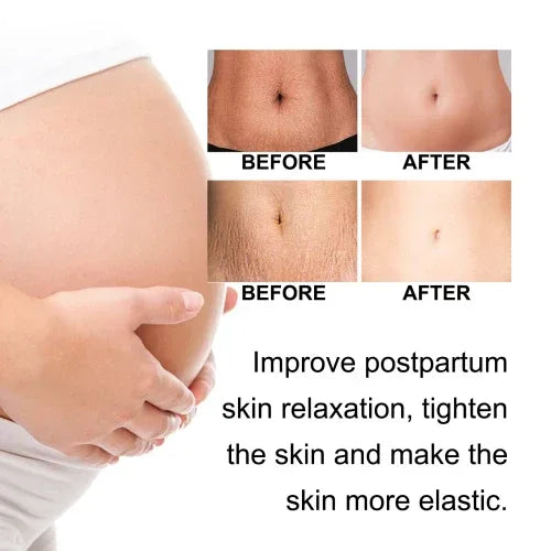 Ouhoe Pregnancy Care Cream Moisturizes Restores Fine Lines Of Postpartum To Firm Soft And Smooth Body Skin - My Vixen Vault